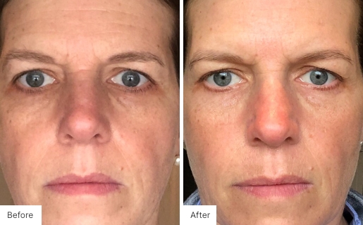 7 - Before and After Real Results photo of a woman's face.